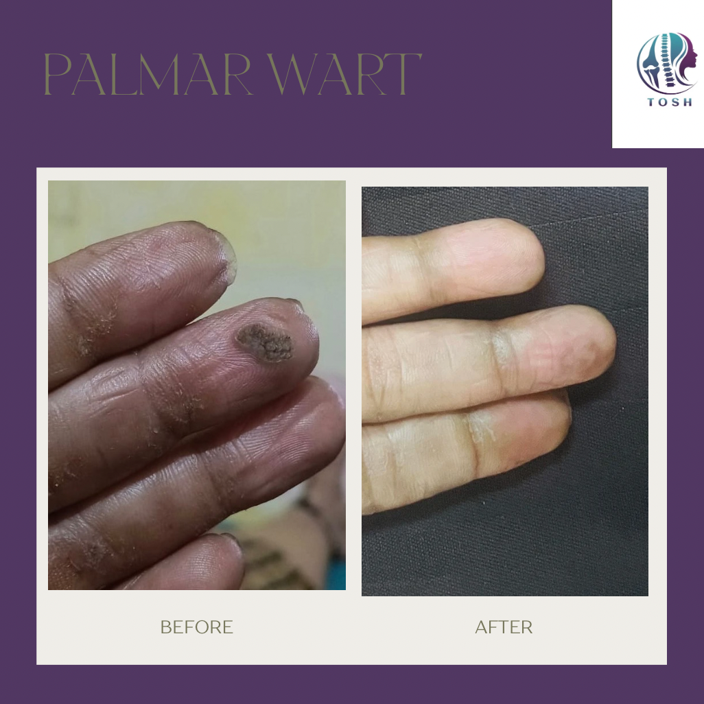 Affordable and best treatment for wart 
 main image