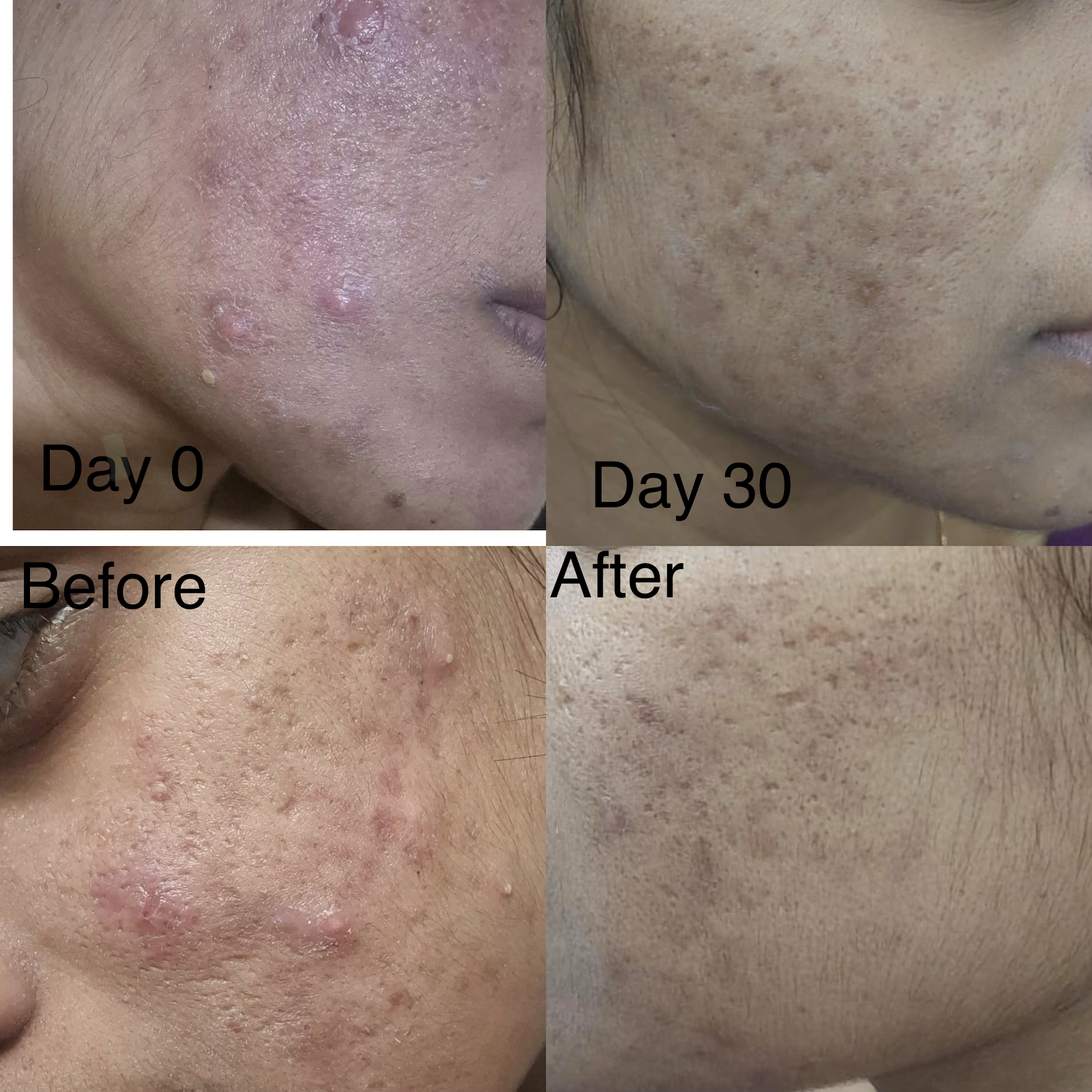Best dermatologist for acne treatment / pimple treatment  main image