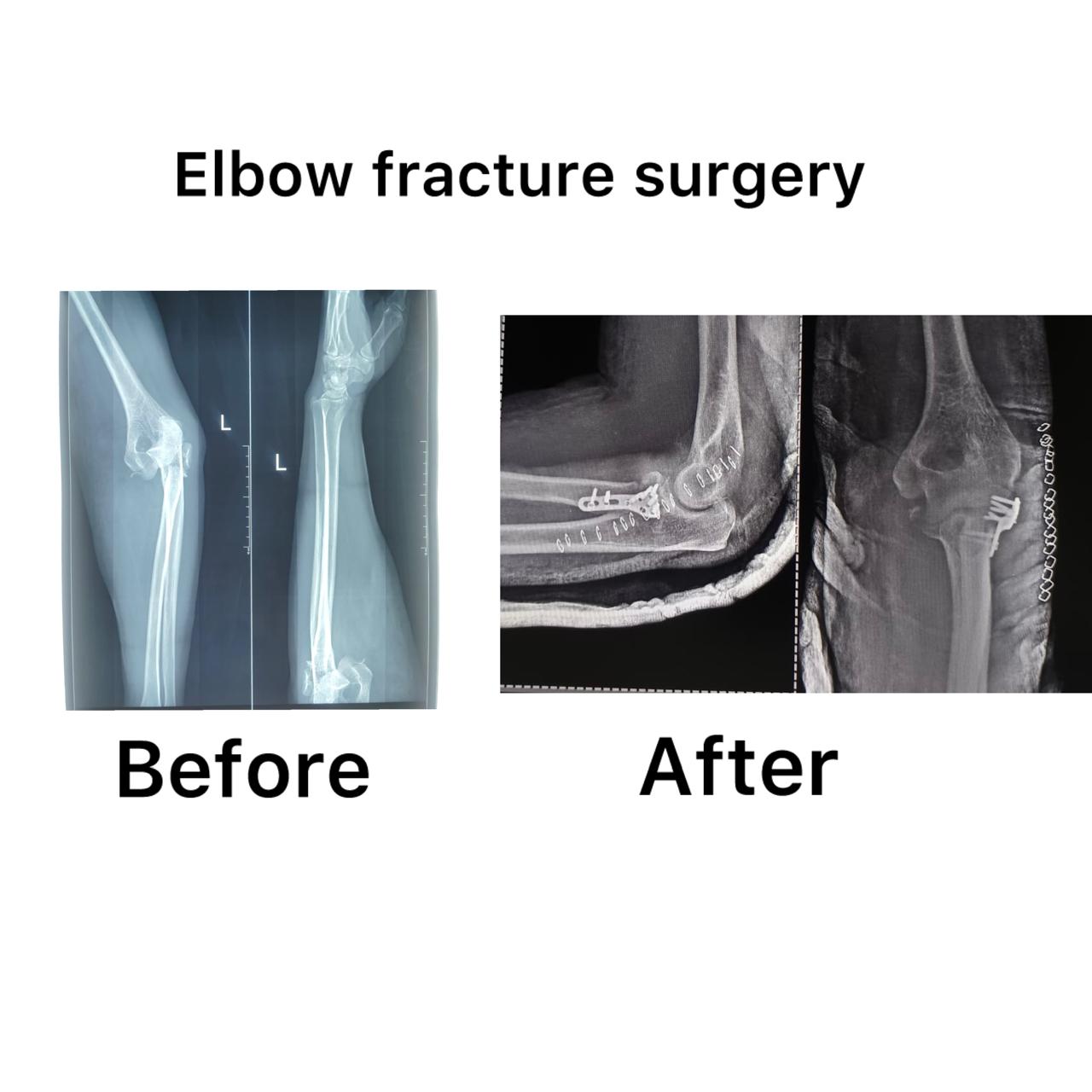 Fracture treatment in Trichy main image