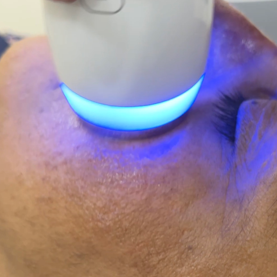 Best skin specialist for melasma treatment in Trichy
 main image