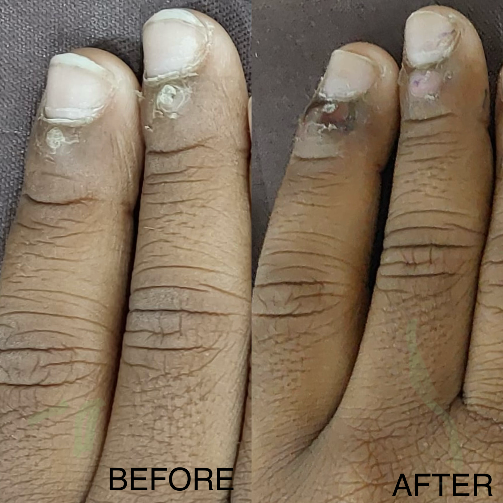 Best skin clinic for wart removal in children in Trichy main image
