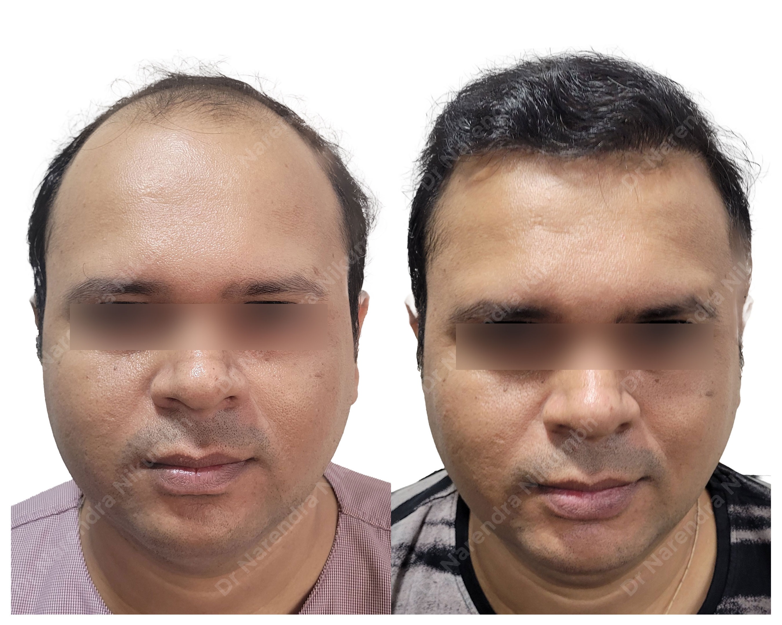 Hair Transplant Clinic in Thane