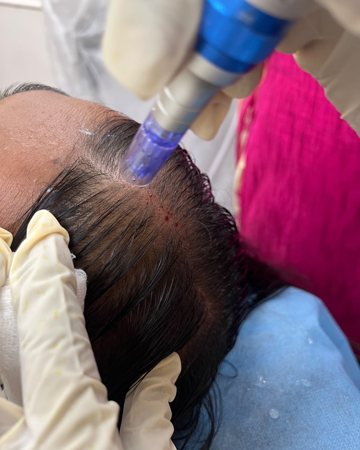 Hairfall treatment in trichy main image