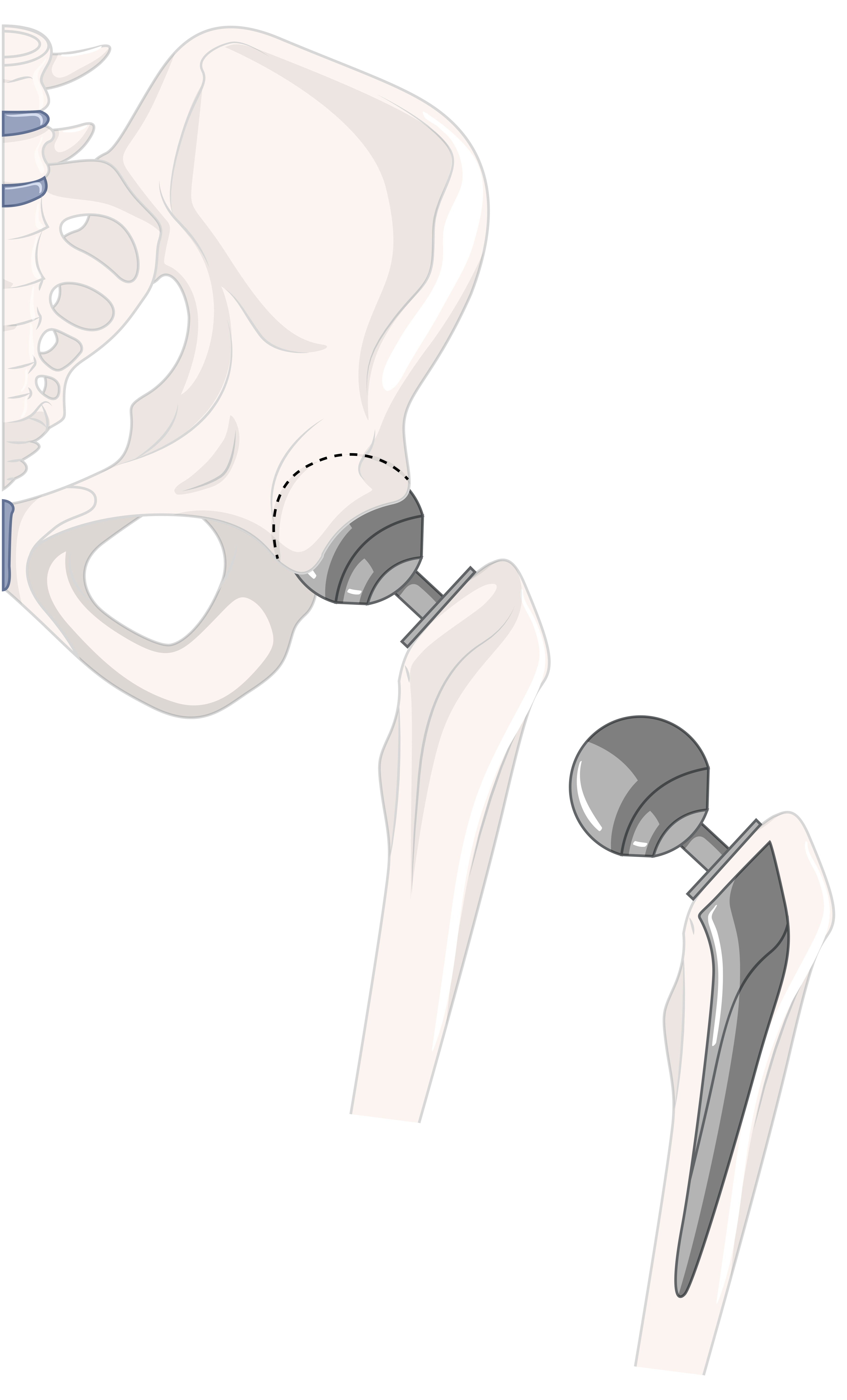 Total Hip Replacement in Chennai | A Modern Solution for Hip Pain main image