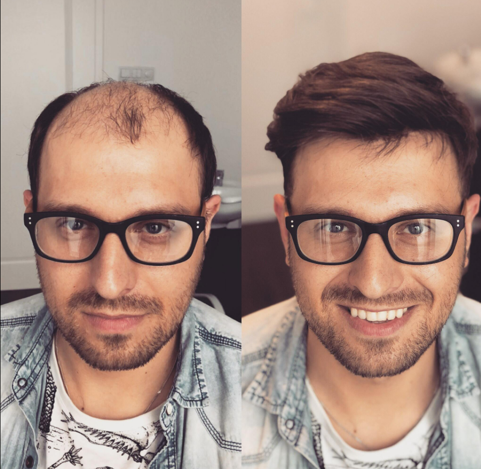 Hair Patch