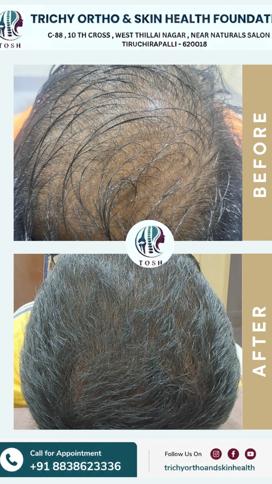 Hair fall treatment in Trichy main image