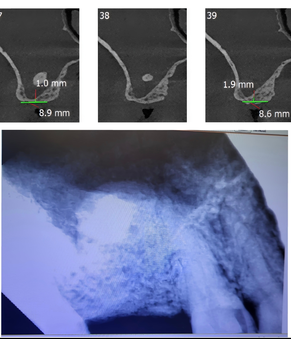 Bone Regeneration main image