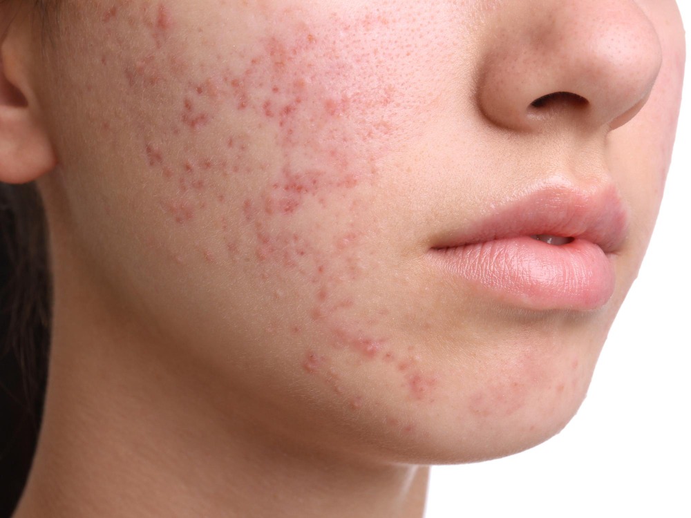 Acne Scar Removal in Chennai: What Treatment Options Really Work? main image