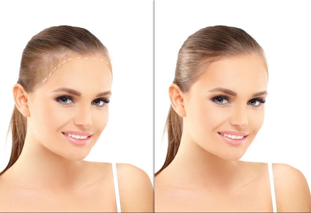 Hair Transplant for Women in Chennai: Understanding the Causes, Procedure, and Expected Results main image