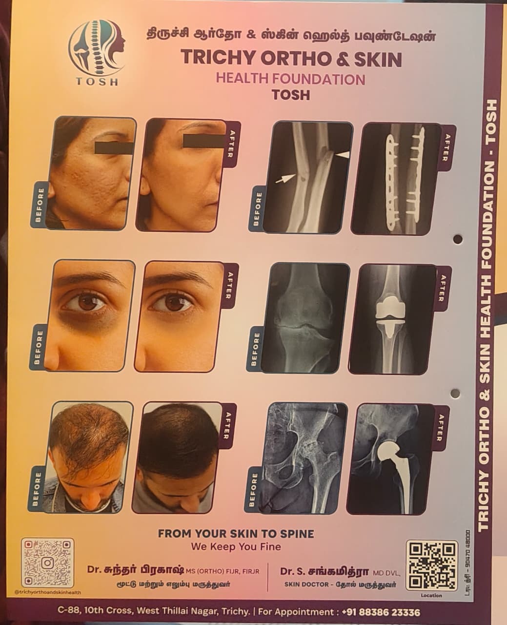 Joint replacement Woraiyur main image