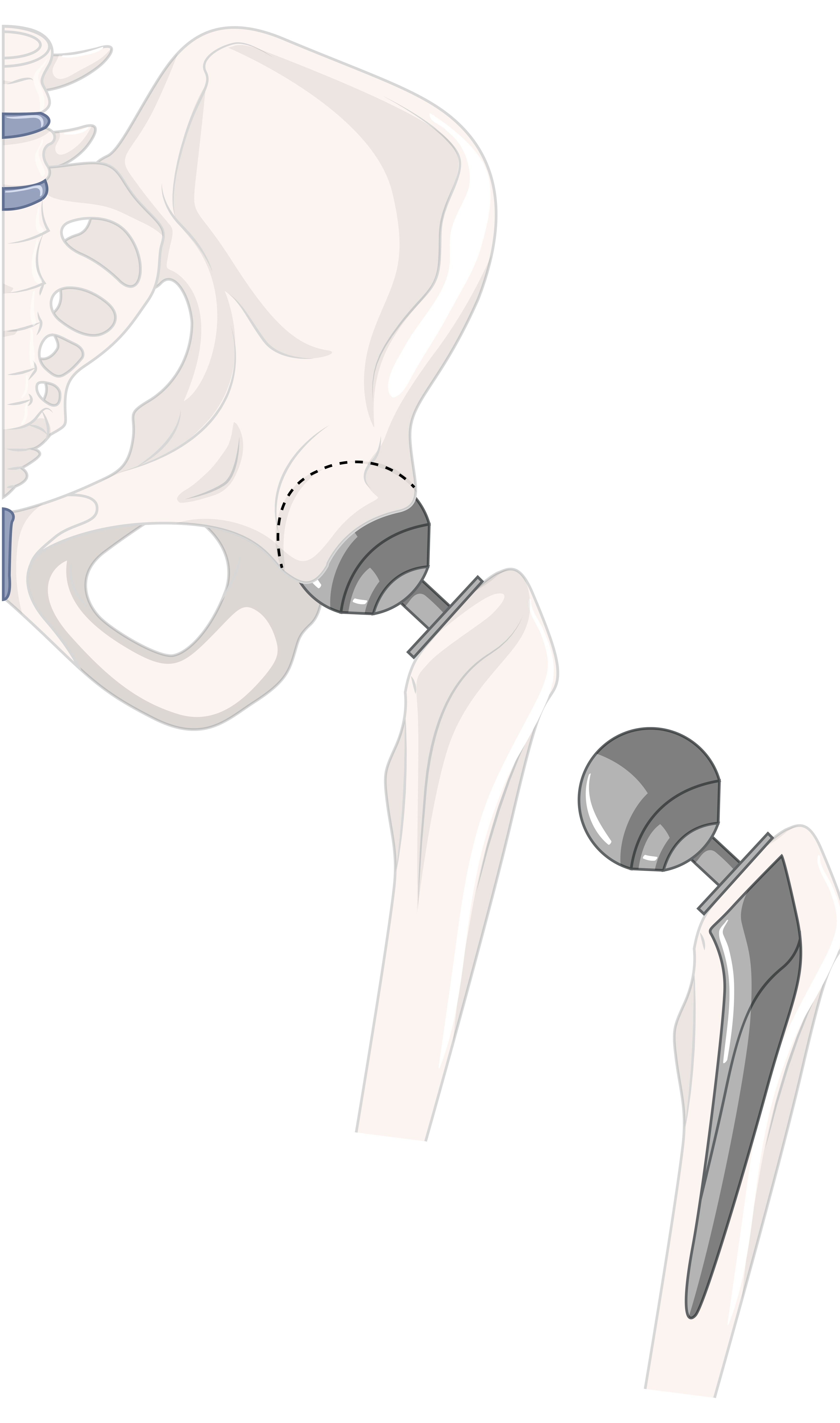 Total Hip Replacement in Chennai and What Patients Should Know Before Surgery main image