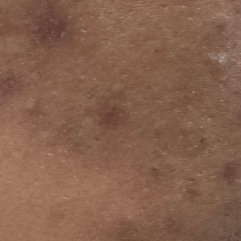 Vibha skin