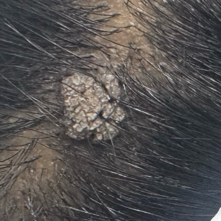 Vibha skin