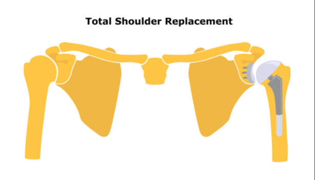 Total Shoulder Replacement in Santacruz, Khar and Bandra for Severe Shoulder Joint Damage