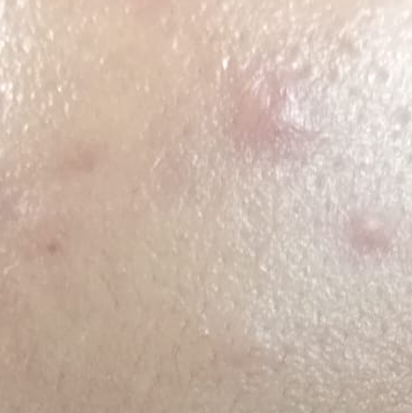 Vibha skin