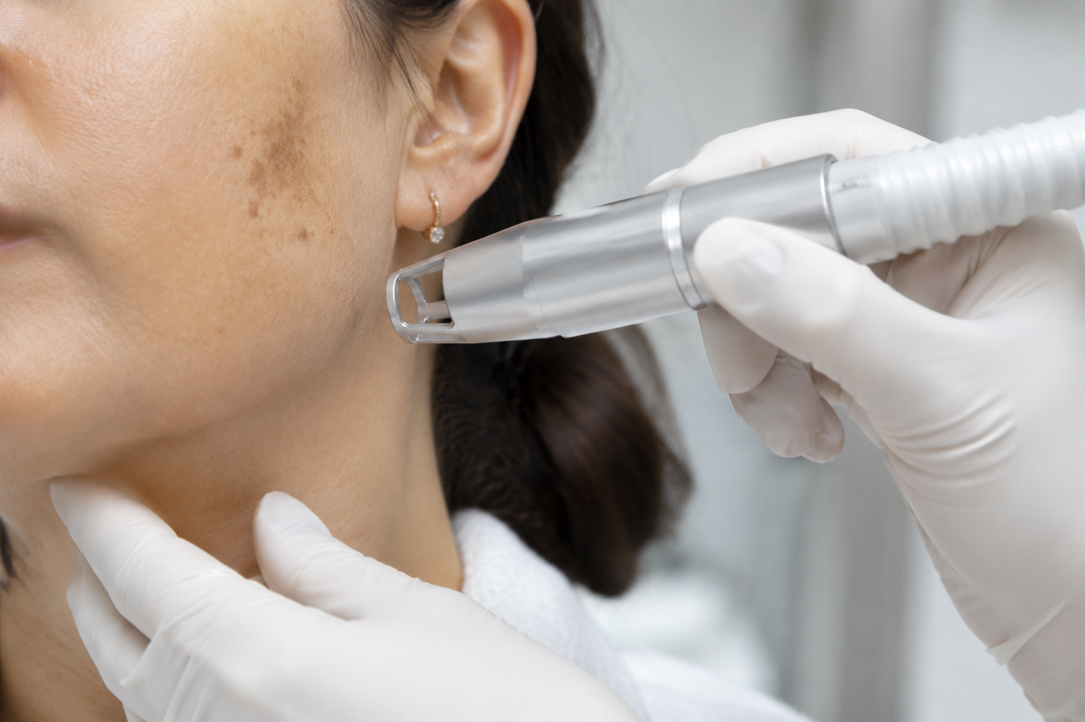 Laser Pigmentation Removal Treatment for Clearer and More Even-Toned Skin