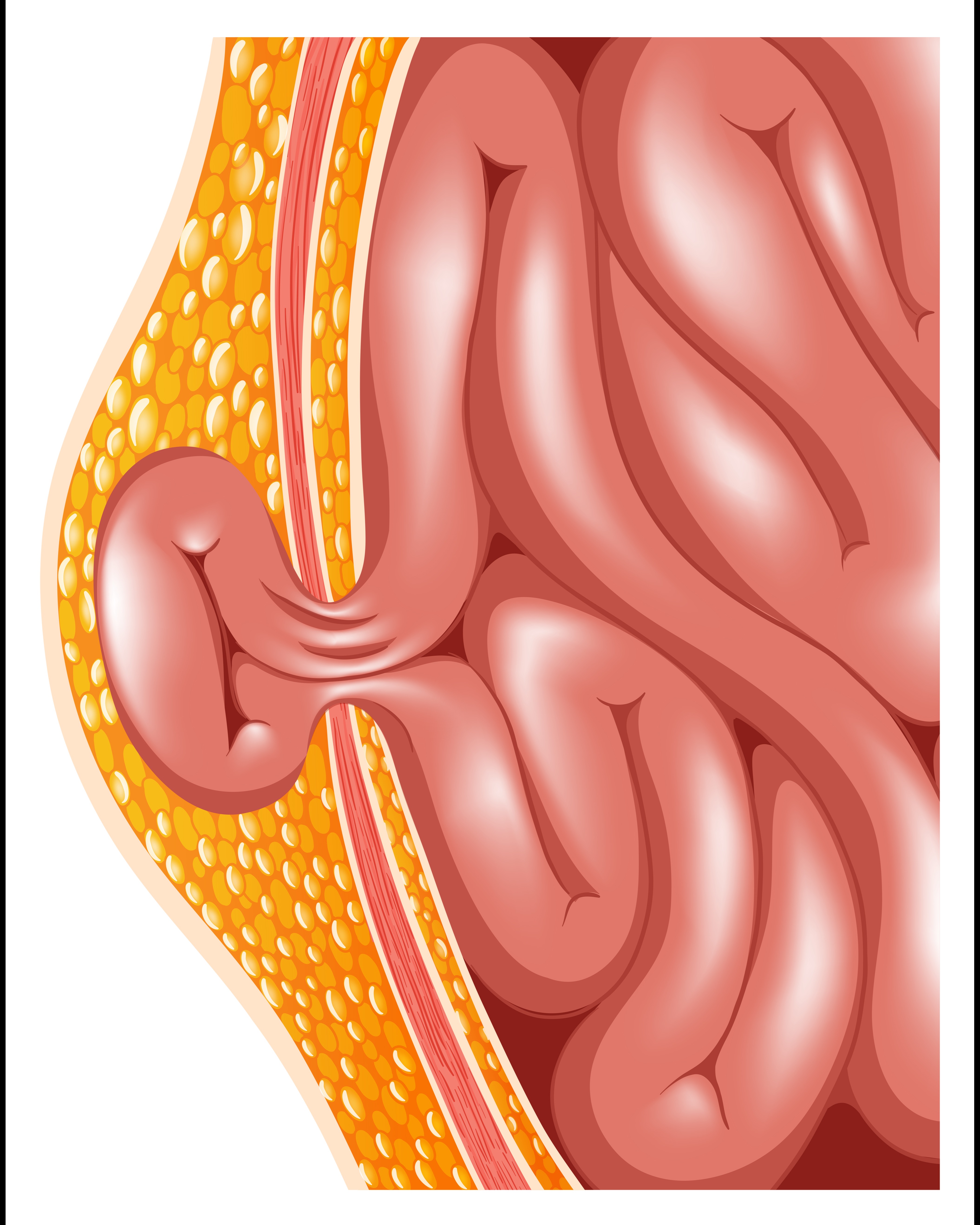 Hernia Surgeon in Pune Understanding Treatment Options and When to Seek Care