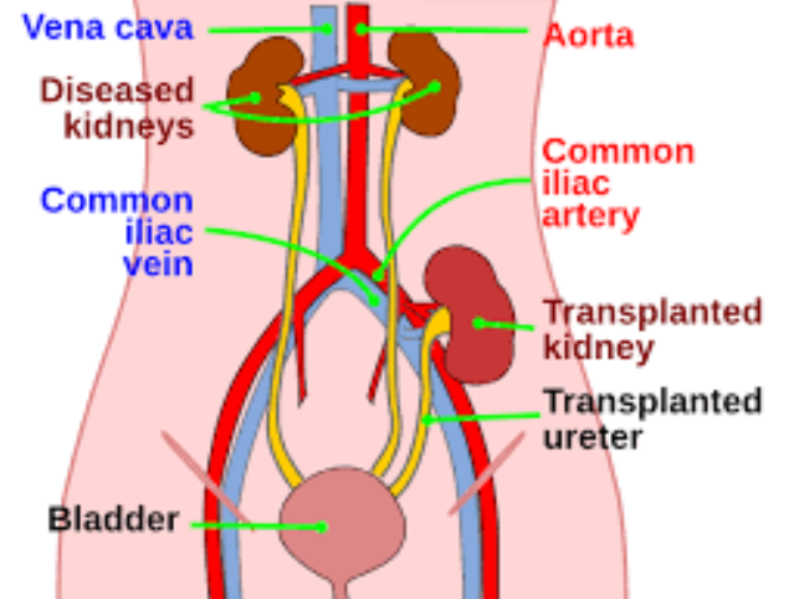Kidney Transplantation in Pune: When Is a Patient Ready for Transplant Evaluation?