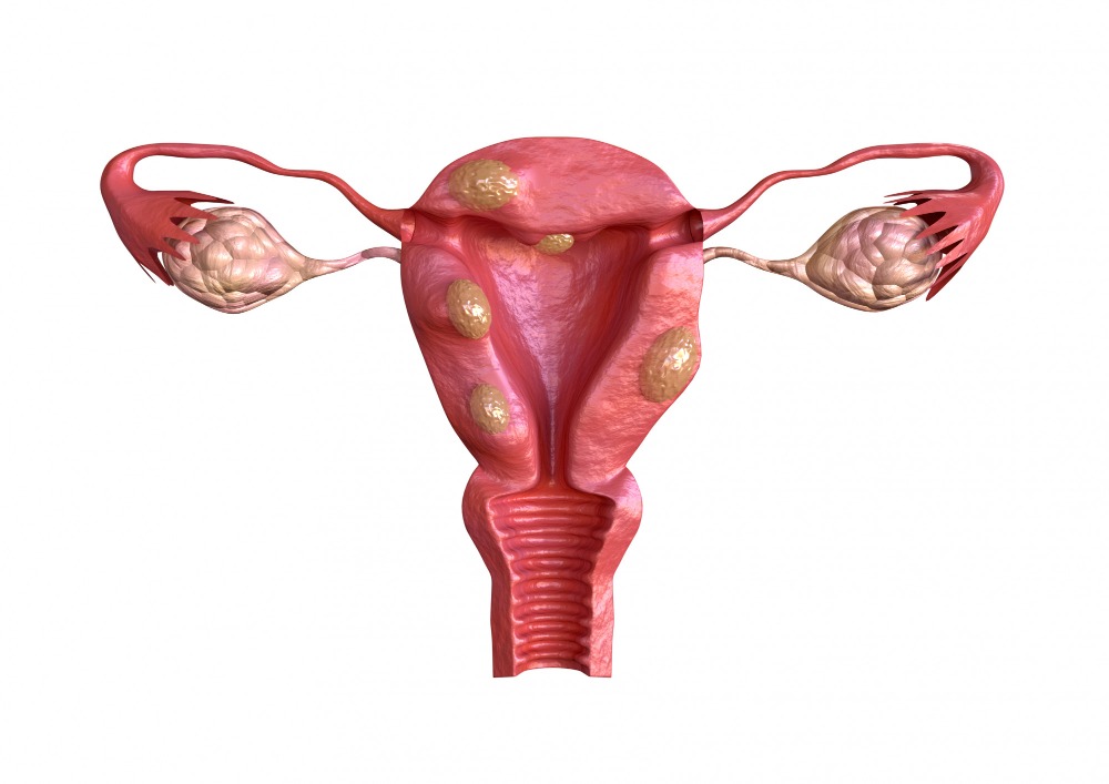 Fibroid Treatment Choices Based on Size Symptoms and Individual Health Needs