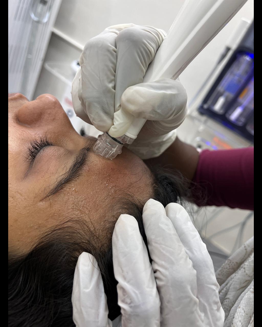 Acne treatment Puthur main image