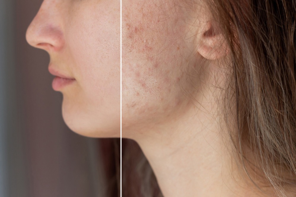 Acne Scars Treatment in MRC Nagar: How to Know Which Procedure Is Right for Your Skin