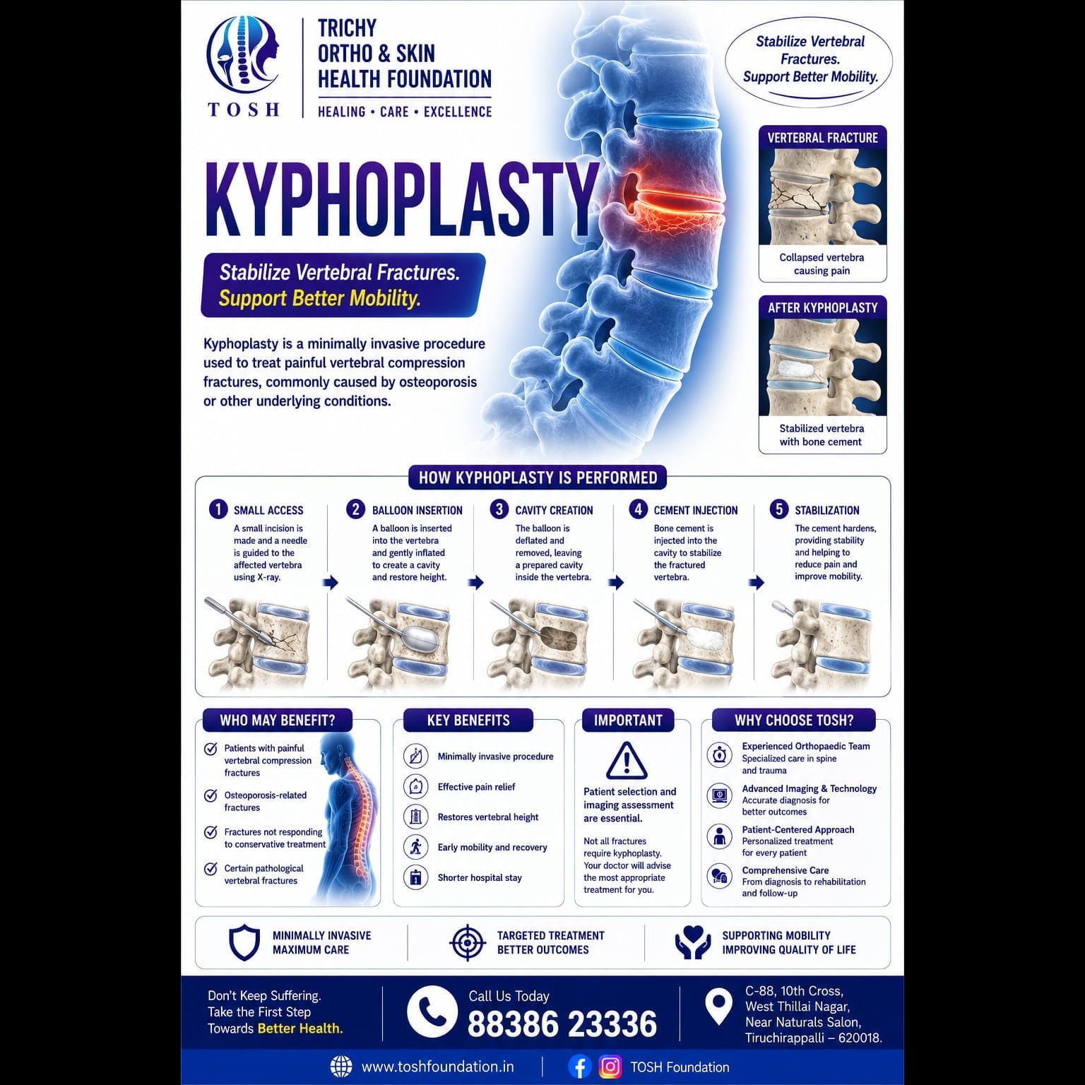 Kyphoplasty main image