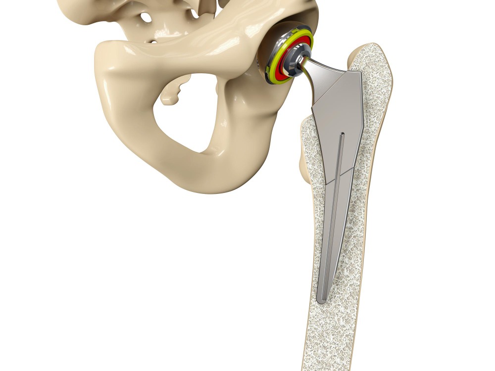 Hip Replacement and TKR Understanding Which Joint Replacement Procedure You May Need in Santacruz