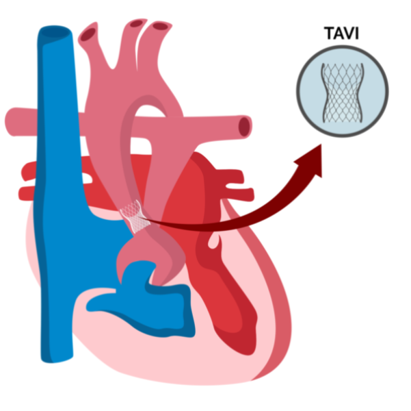 TAVI in Kalyan: How Transcatheter Aortic Valve Implantation Helps Treat Severe Aortic Valve Disease