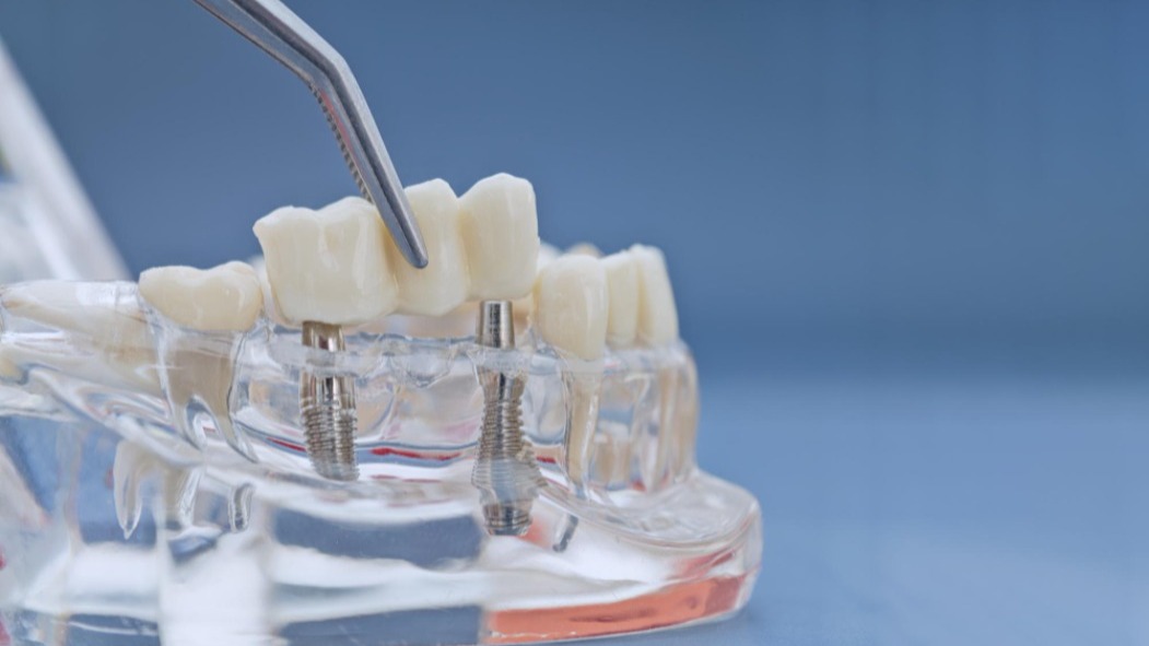Crown and Bridge Placement in Bhukum for Damaged and Missing Teeth