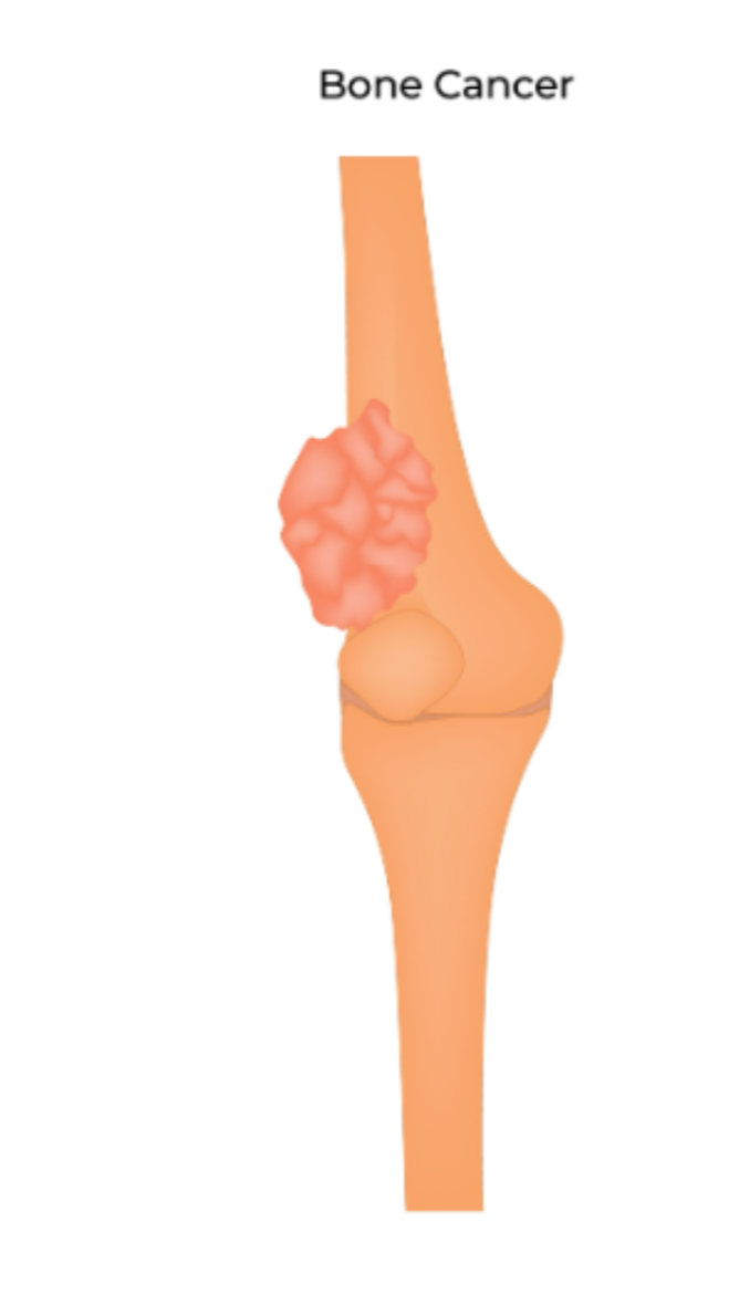 Bone Cancer Treatment Planning What Happens From Diagnosis to Surgery