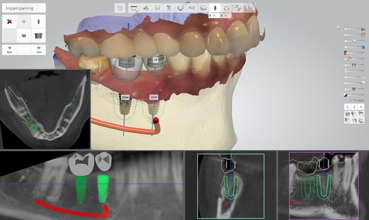 How to Prepare for Dental Implant Surgery: A Complete Patient Guide
