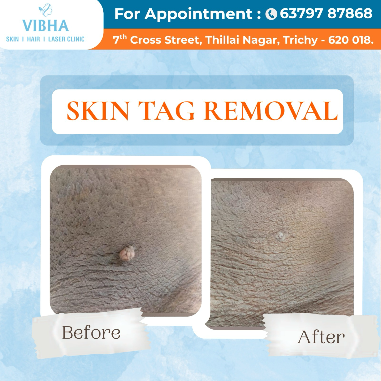 Vibha skin