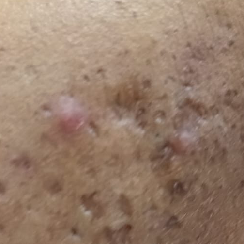 Vibha skin