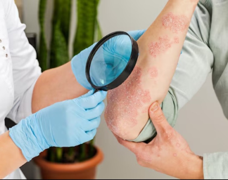 Fungal Infection Treatment Specialist Care for Healthy Skin Recovery