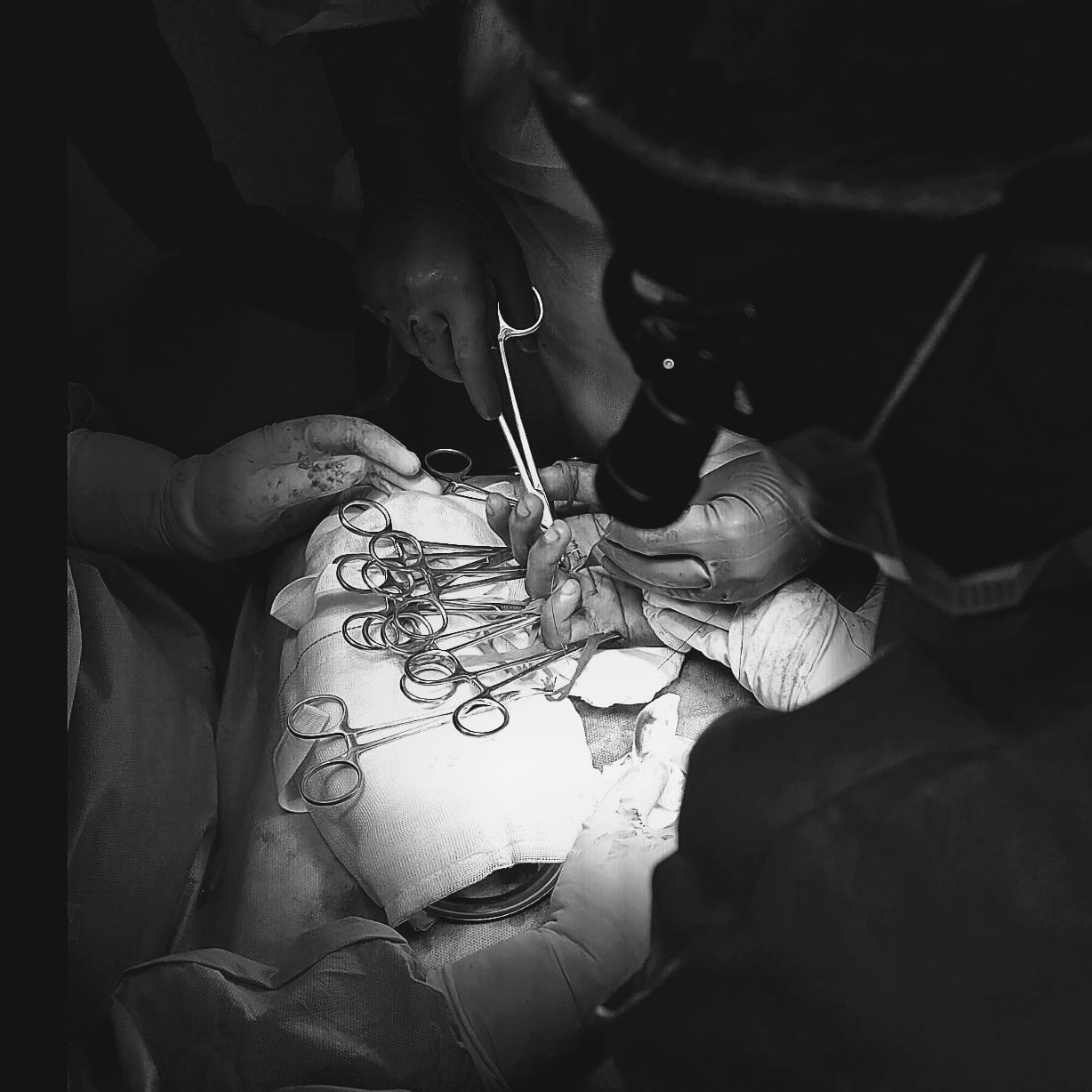 Hand surgery - Tendon transfer main image
