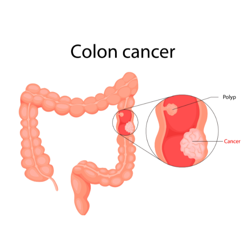 Colon Cancer Screening in Mumbai Who Should Discuss Screening With a Gastroenterologist?