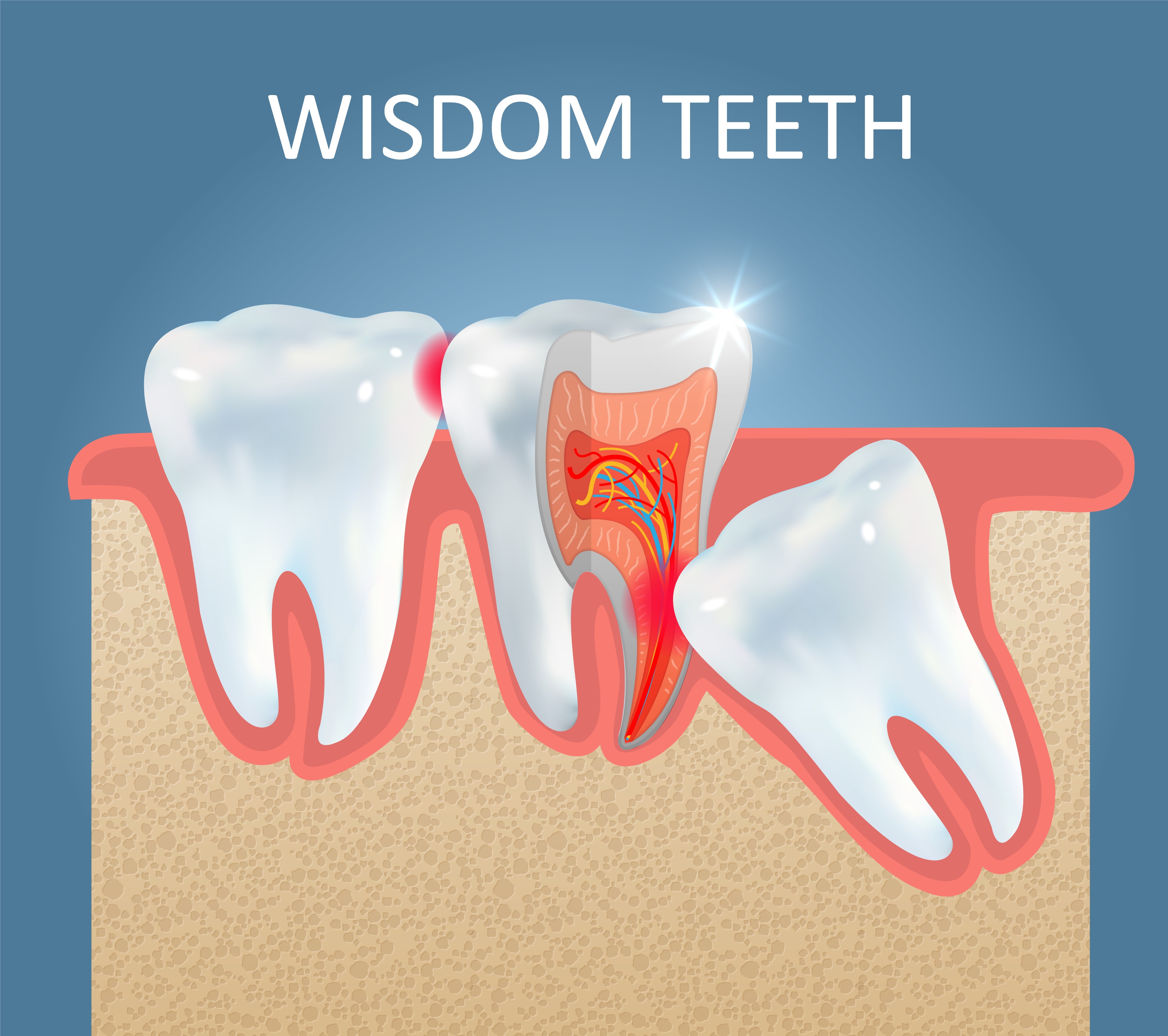 What to Expect During Wisdom Tooth Removal and the Days After It