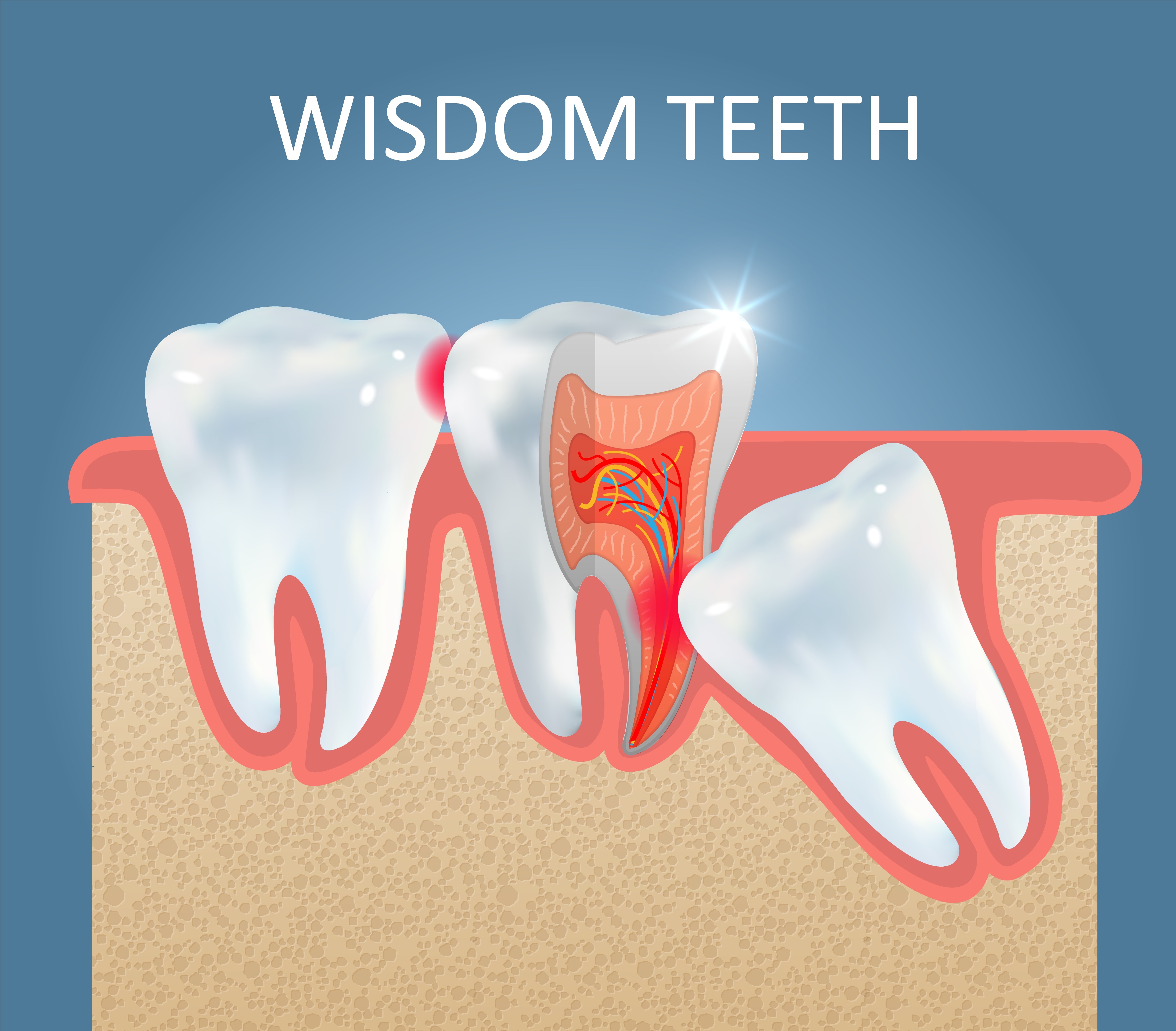 Finding the Right Wisdom Tooth Removal Treatment for Persistent Dental Problems