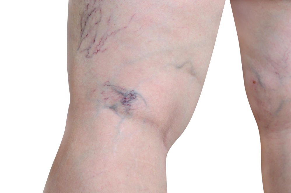 Varicose Veins Treatment in Hinjewadi and Signs It Is Time for a Specialist Evaluation