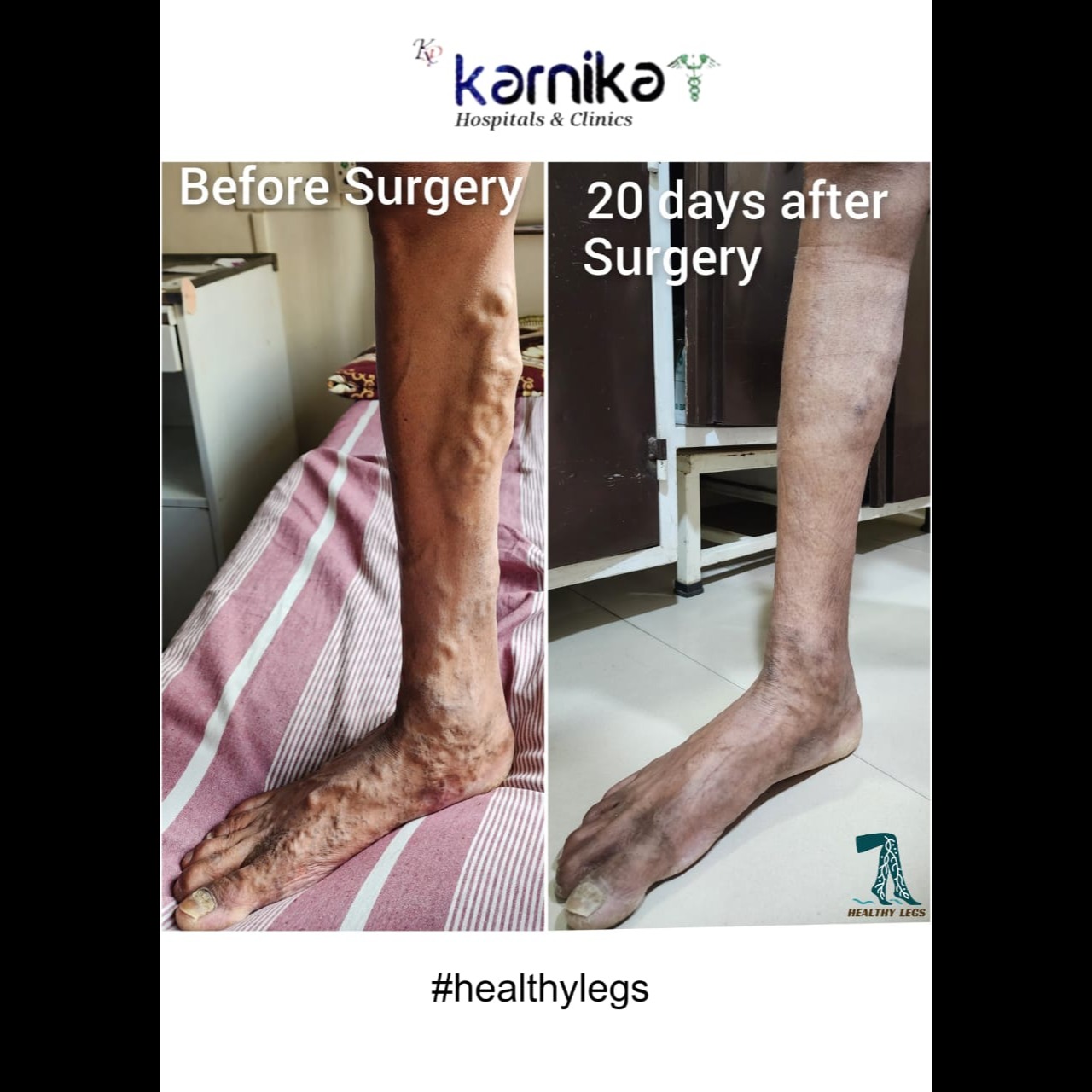 Vericose Veins Treatment in Pune