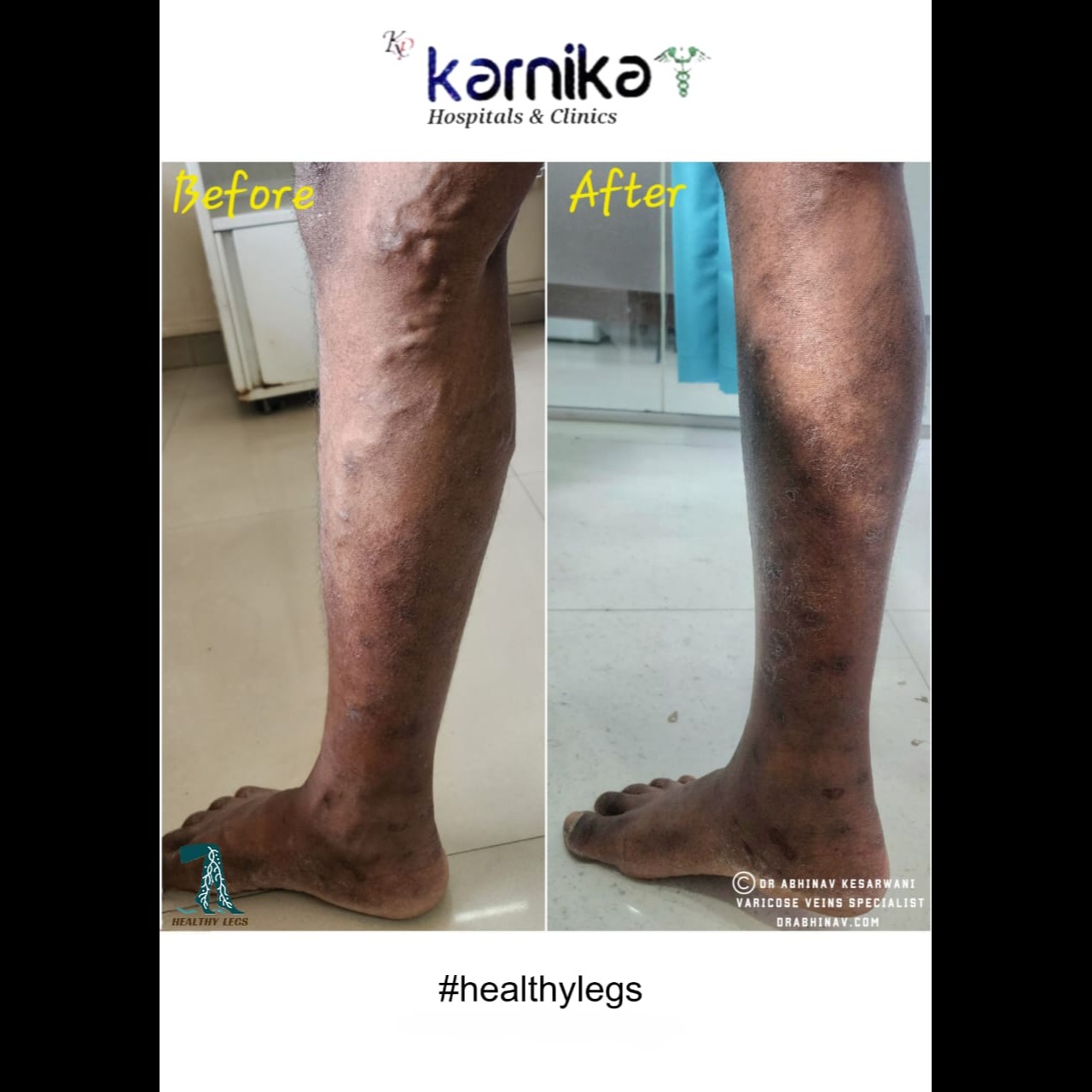 Varicose Vein Doctor in Pune