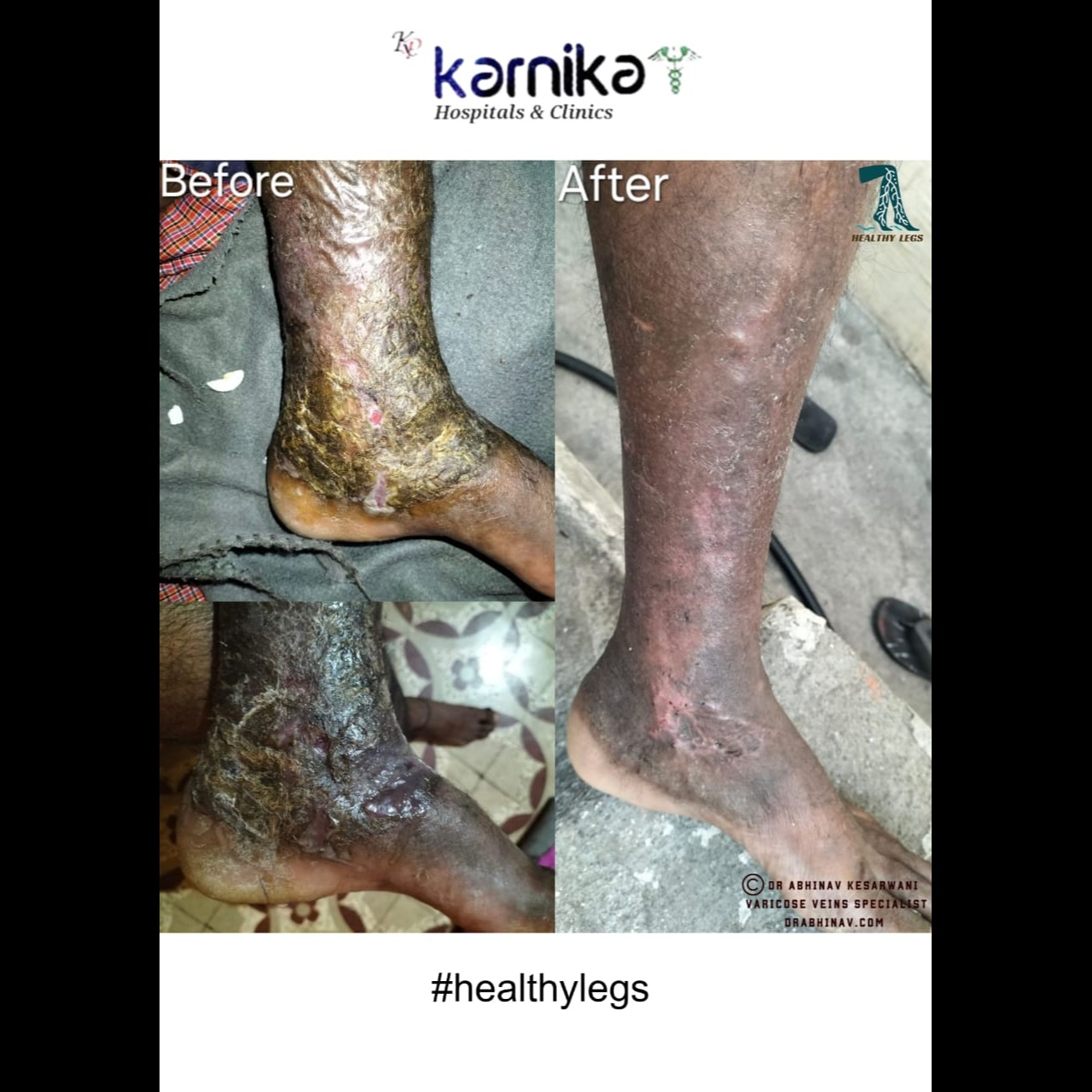 Vericose Veins Specialist in Pune