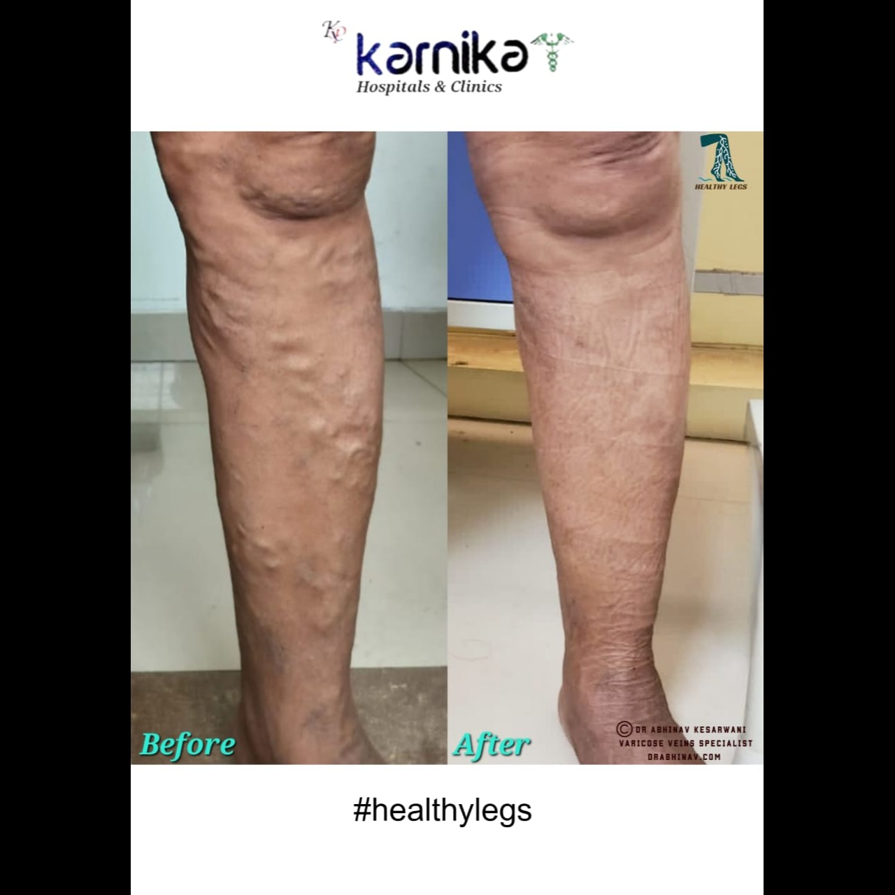 Vericose Veins Treatment in Pune