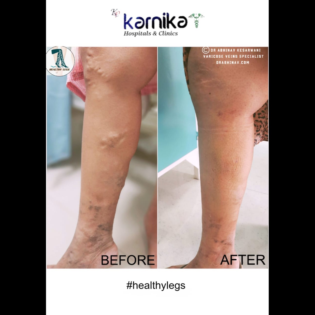 Vericose Veins Specialist in Pune