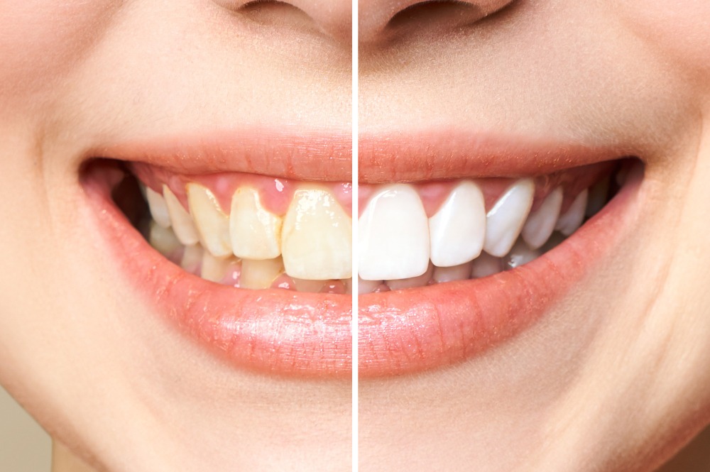 Professional Teeth Whitening in Mumbai or Store-Bought Products