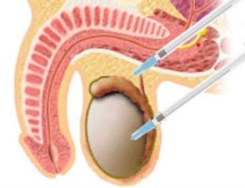 Surgical Sperm Retrieval When It May Be Needed in Male Infertility Treatment