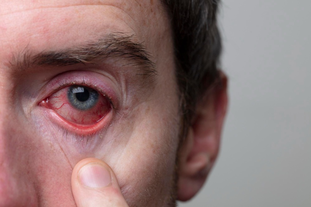 Dry Eye Treatment in Prabhadevi and Why Repeated Eye Drops May Not Be Enough