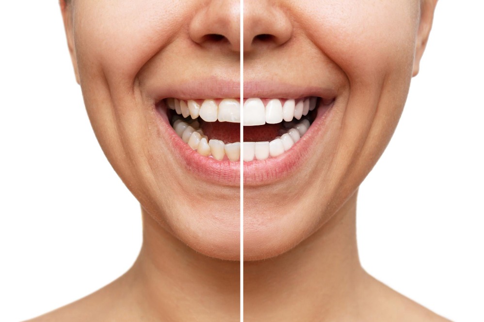 Veneers and Smile Correction in Patlipada, Thane West for Shape Colour and Spacing Concerns
