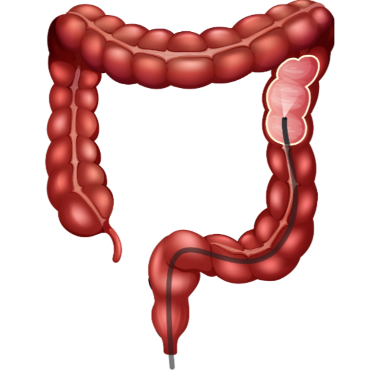 Colonic Polyps When Should They Be Removed and How Is Follow-Up Decided?