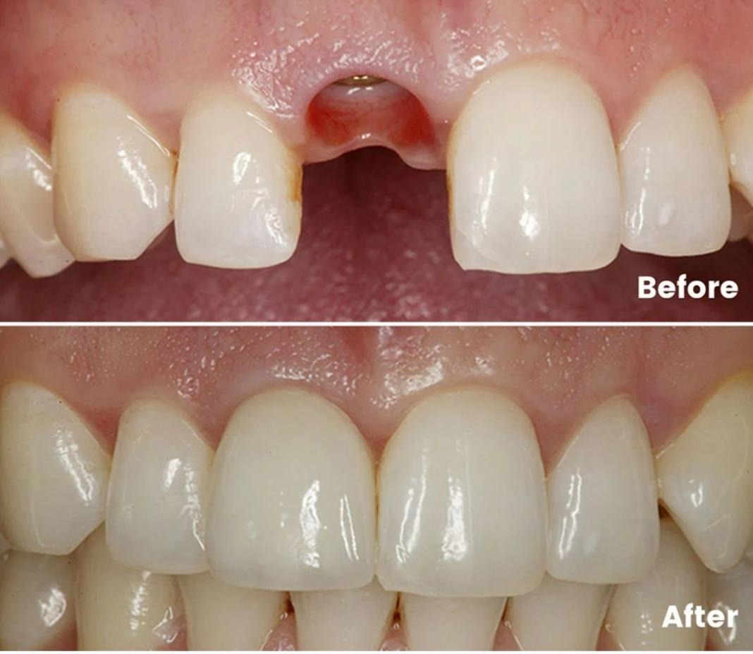 Front Tooth Implant vs Bridge: Which Looks More Natural?
